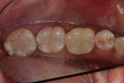 Composite or “Tooth Colored” Fillings - Albany