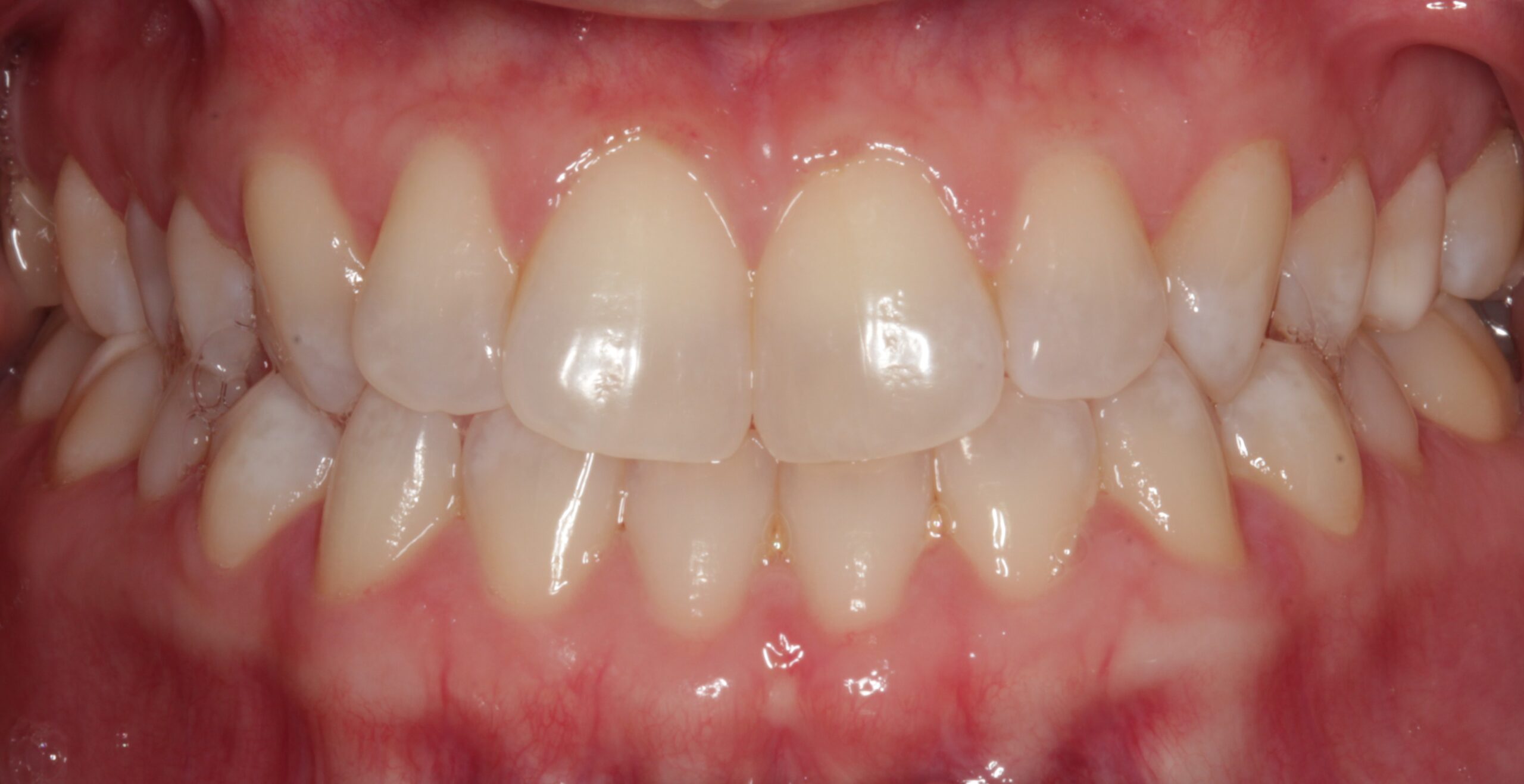 Healthy Gums - Routine Cleaning