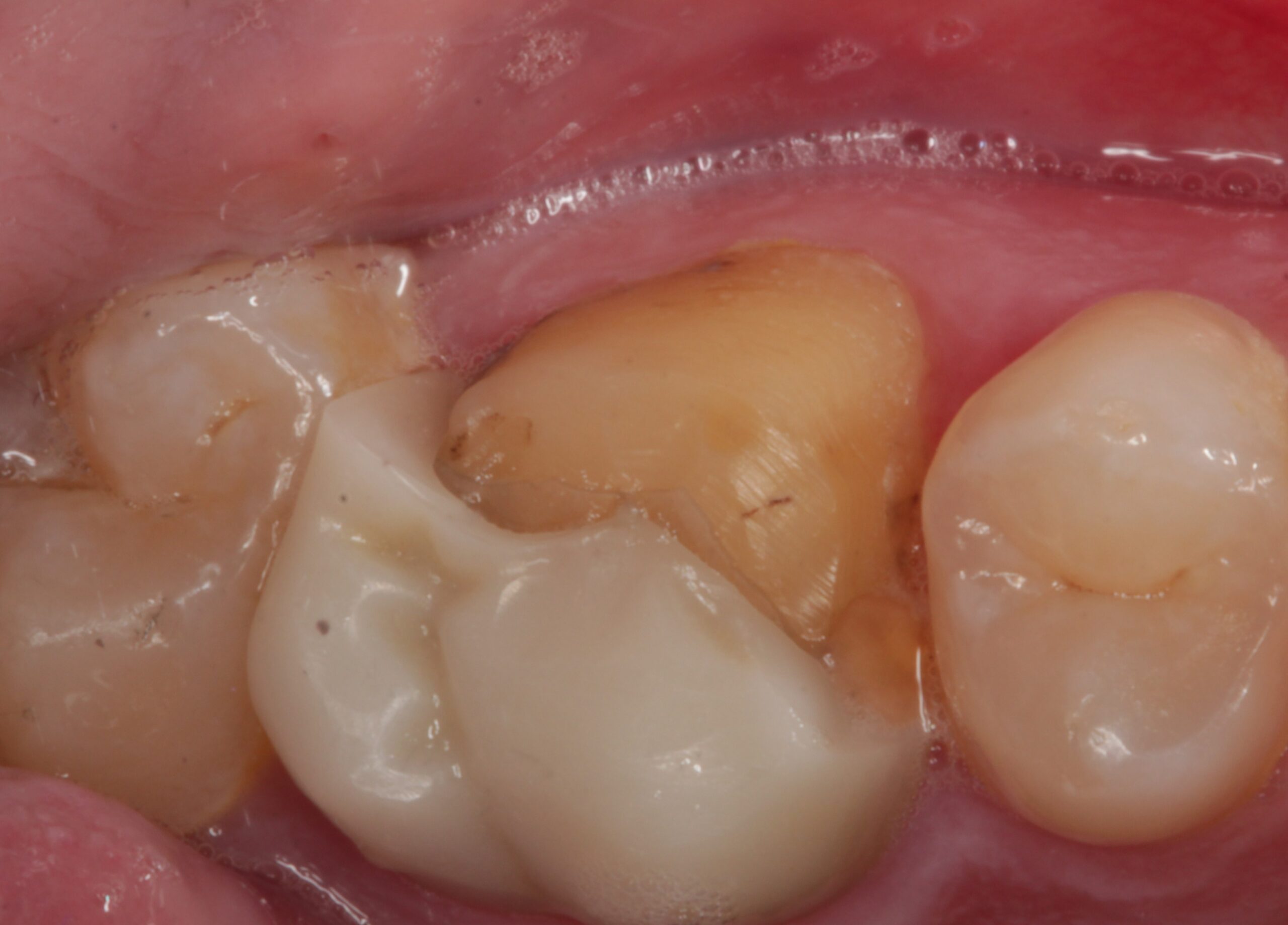 fractured crown before replacement
