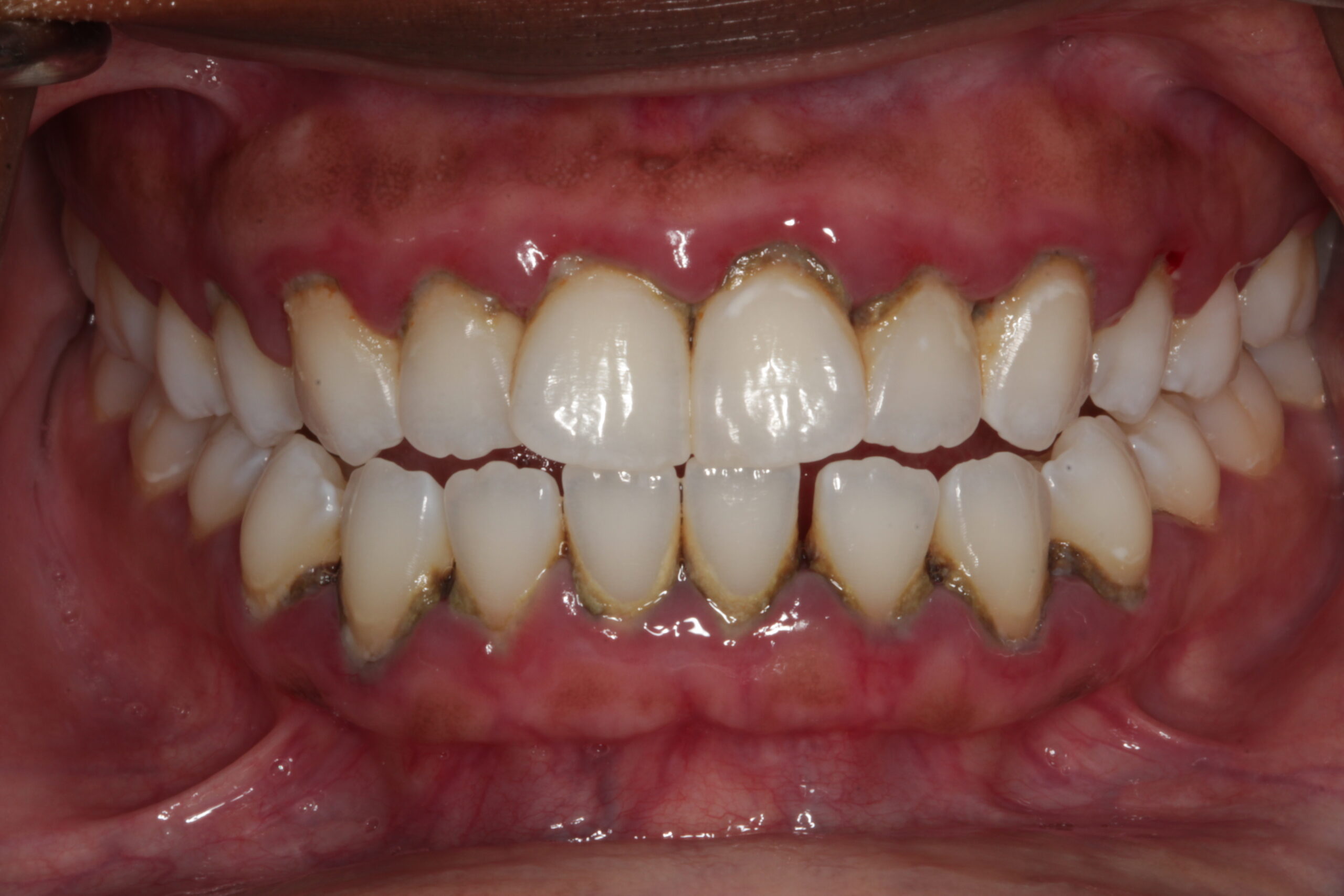 Stage III, Grade B Periodontal Disease